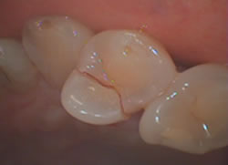 歯の破折