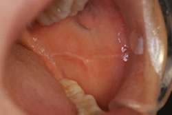 咬合縫線と舌圧痕1