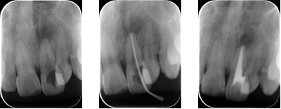 歯内療法の症例