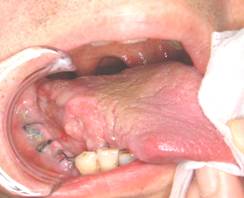 悪性腫瘍（口腔がん）症例2