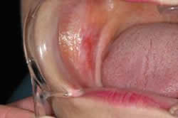 扁平苔癬（へんぺいたいせん）症例1