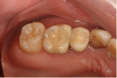 セラミックインレーによる虫歯治療1