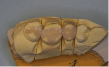 セラミックインレーによる虫歯治療3