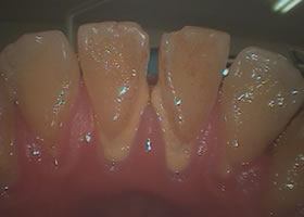 歯石1
