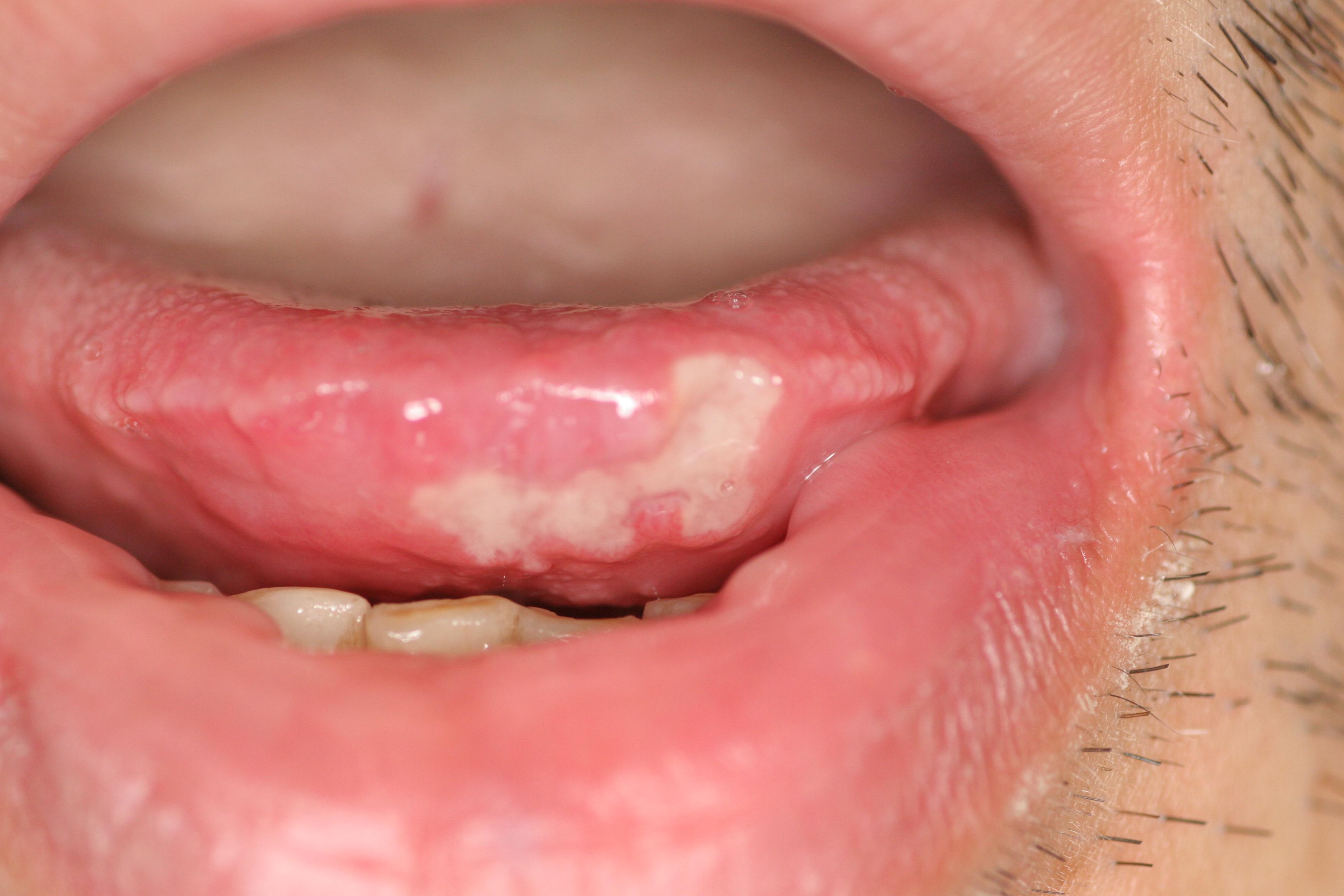 口内炎 舌 の 横