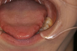 咬合縫線と舌圧痕2