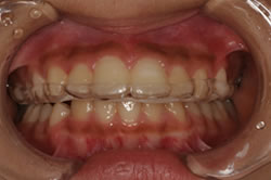 歯ぎしり対策1