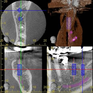 インプラント術前診査