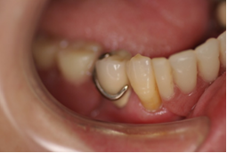 レジン床の義歯3