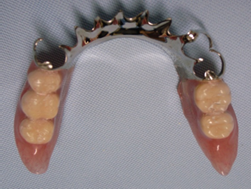 メタルフレームの義歯1