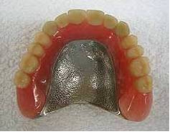 メタルフレームの義歯2