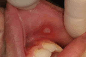 口内炎（再発性アフタ）症例1