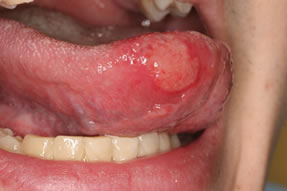 口内炎（再発性アフタ）症例2
