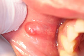 粘液嚢胞症例4