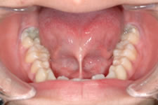 舌小帯異常・舌強直症症例1