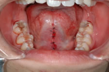 舌小帯異常・舌強直症症例2