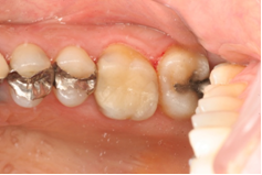 セラミックインレーによる虫歯治療2