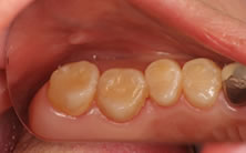 セラミックインレーによる虫歯治療4