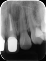 歯根嚢胞1