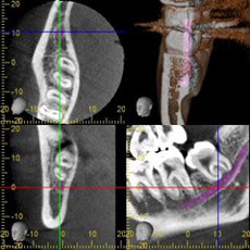親知らずとCT検査