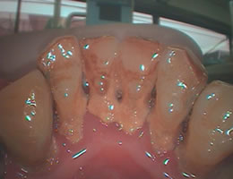 歯石2