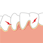 歯肉が腫れている
